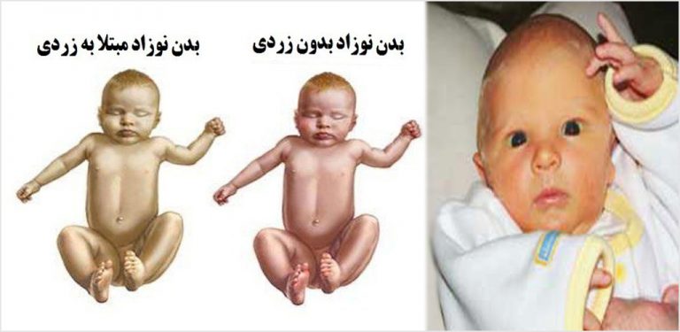 نشانه زردی نوزادان تهران اینترنتی